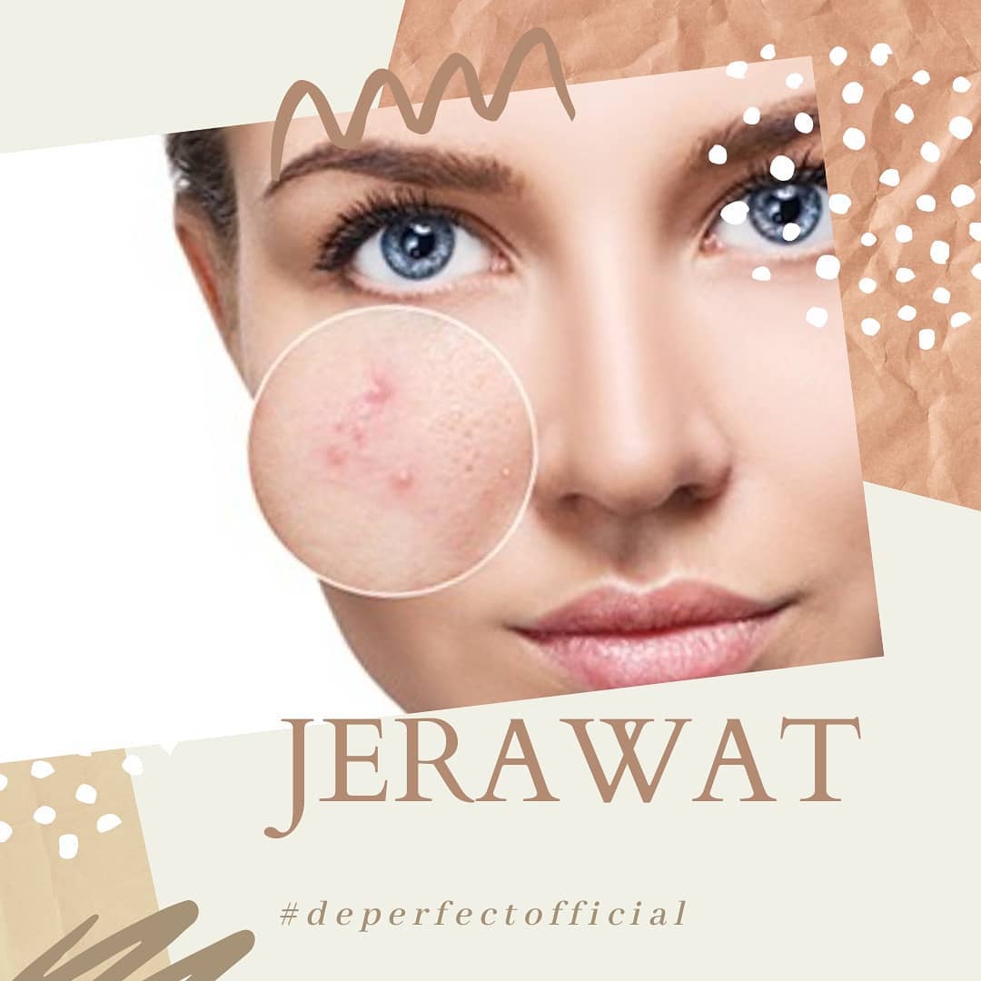 Jerawat Memahami Jerawat