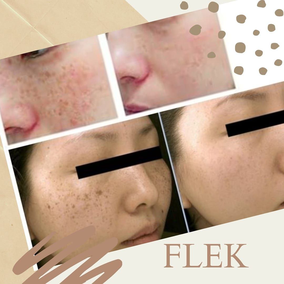 flek hitam atau melasma