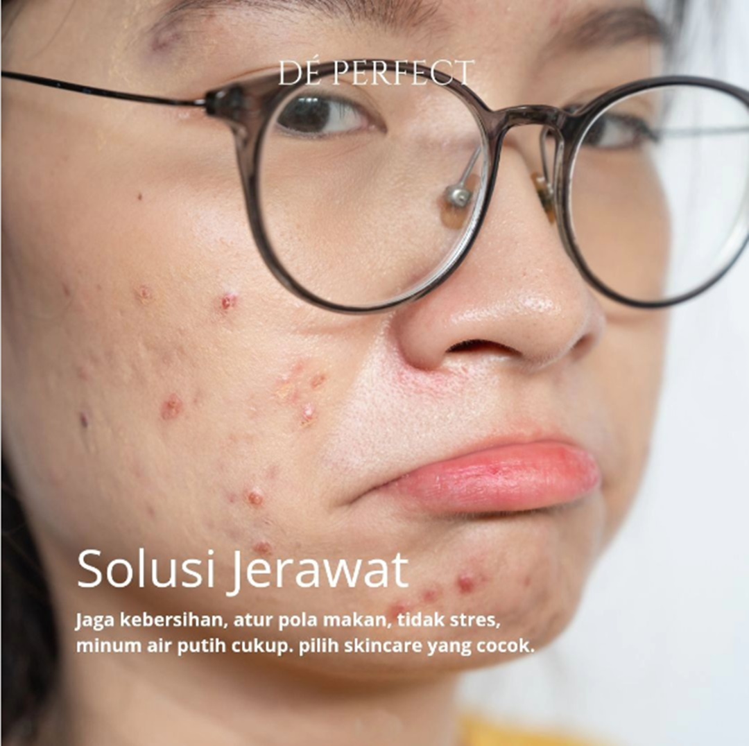 Edukasi Jerawat dan Solusi