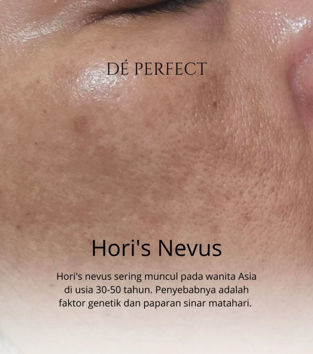 hori's nevus