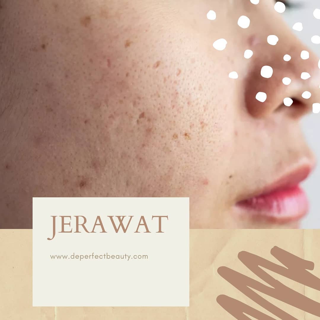 Faktor yang menyebabkan Jerawat Faktor yang menyebabkan Jerawat