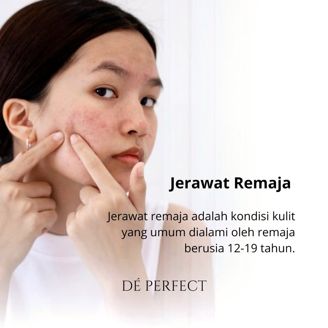 Jerawat Remaja