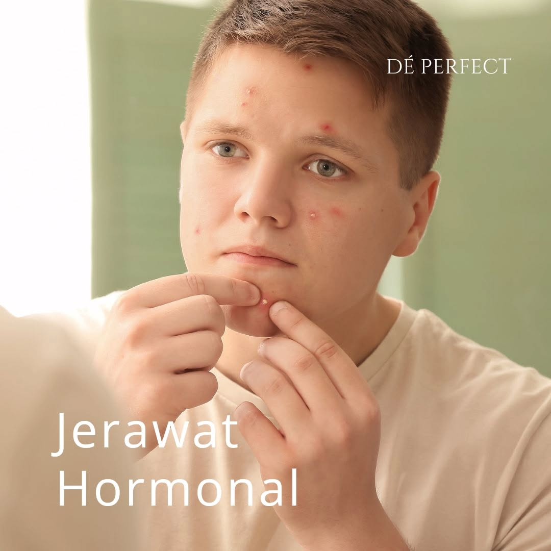 Jerawat Hormonal