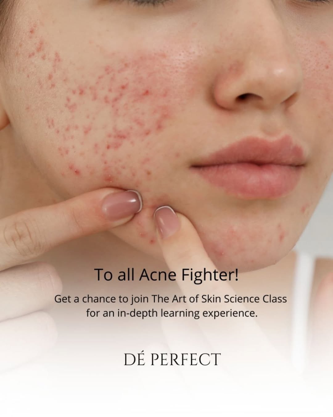 program seni merawat kulit spesial acne fighter.