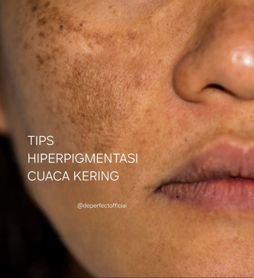 Hiperpigmentasi Hiperpigmentasi
