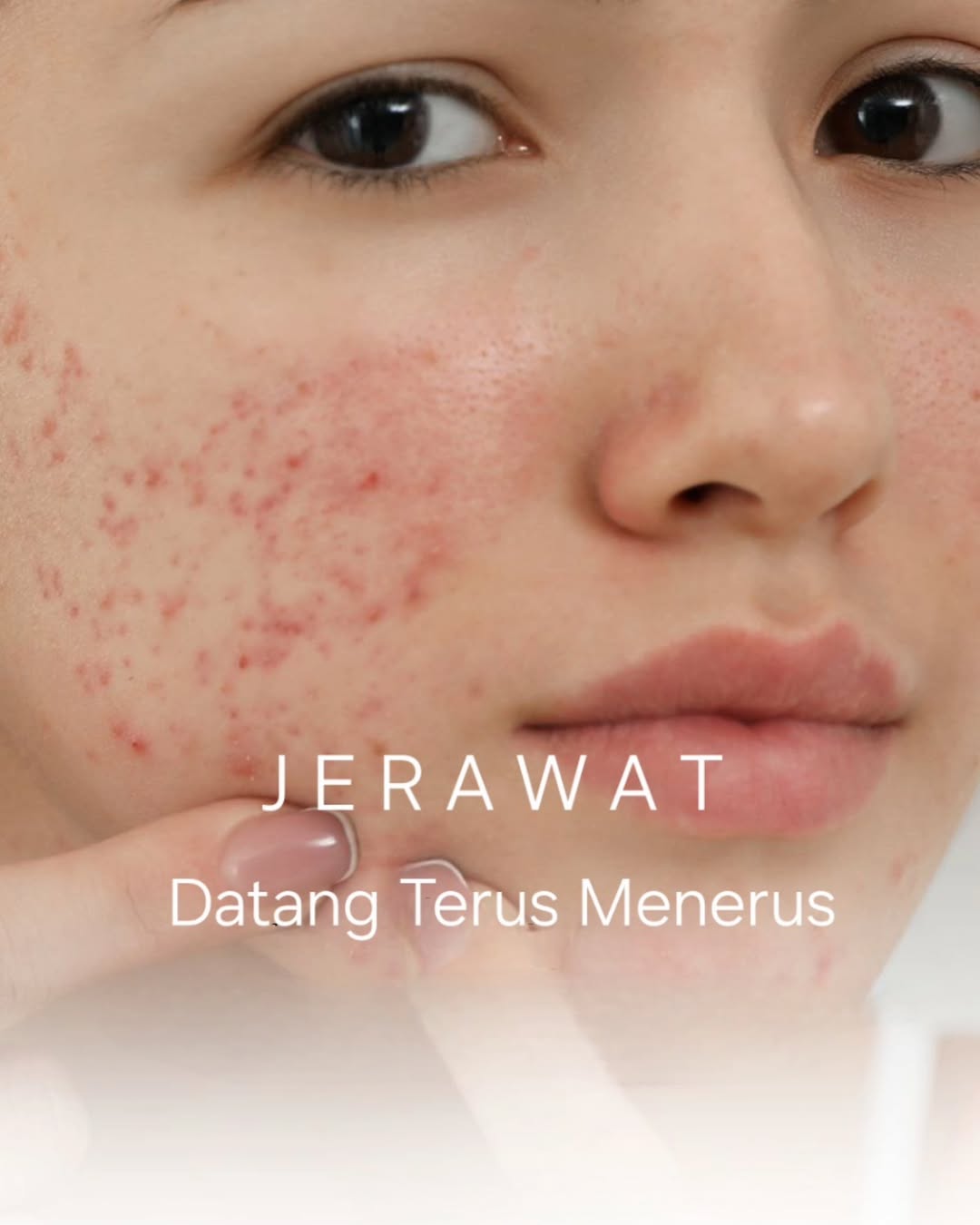 Jerawat Muncul Kembali Jerawat Muncul Kembali