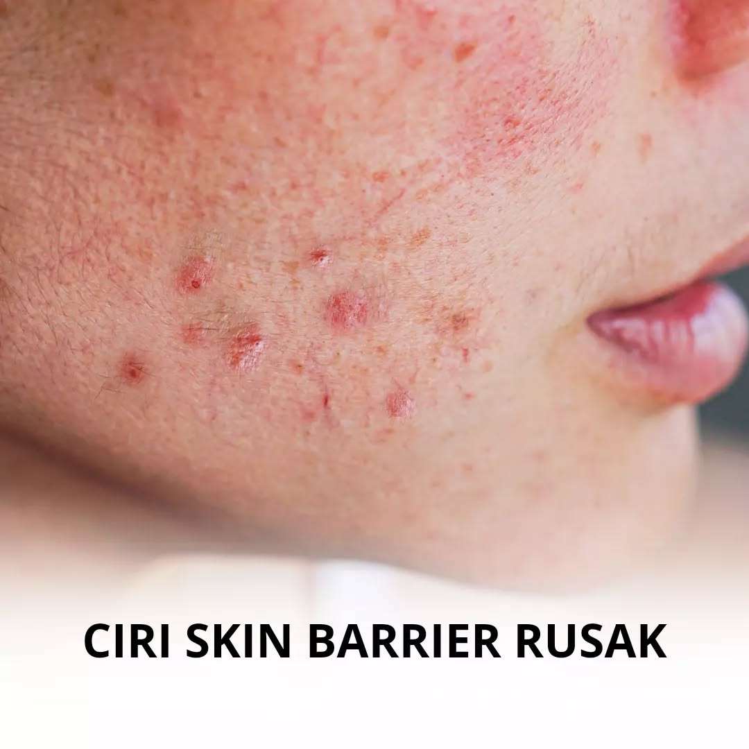 Ciri Skin Barrier Rusak ciri skin barrier rusak