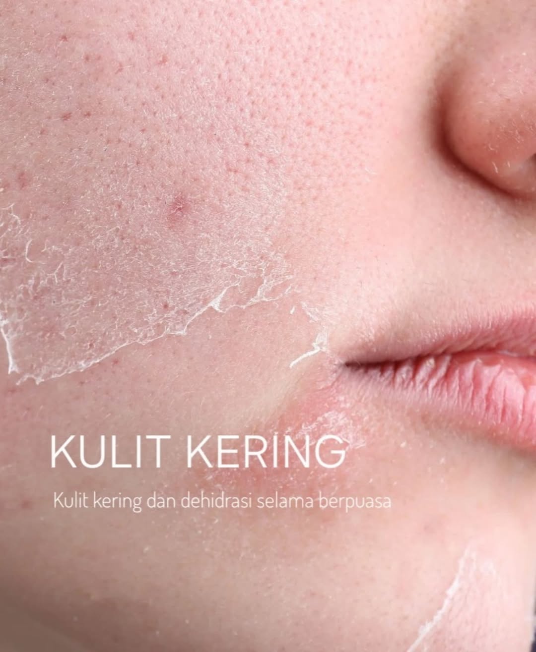 Kulit kering selama puasa