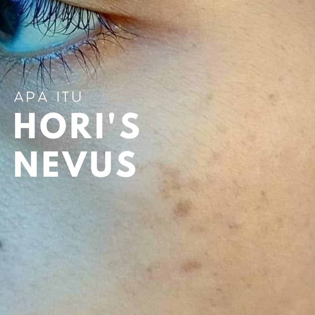 Mengenal Hori’s Nevus Mengenal hori's nevus