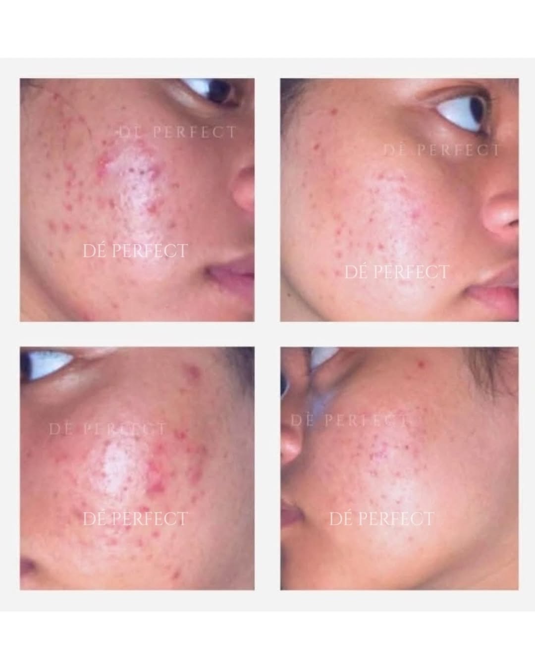 Problem Acne