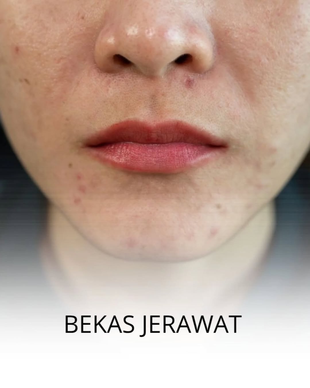 kasus bekas jerawat lebih mudah dihilangkan