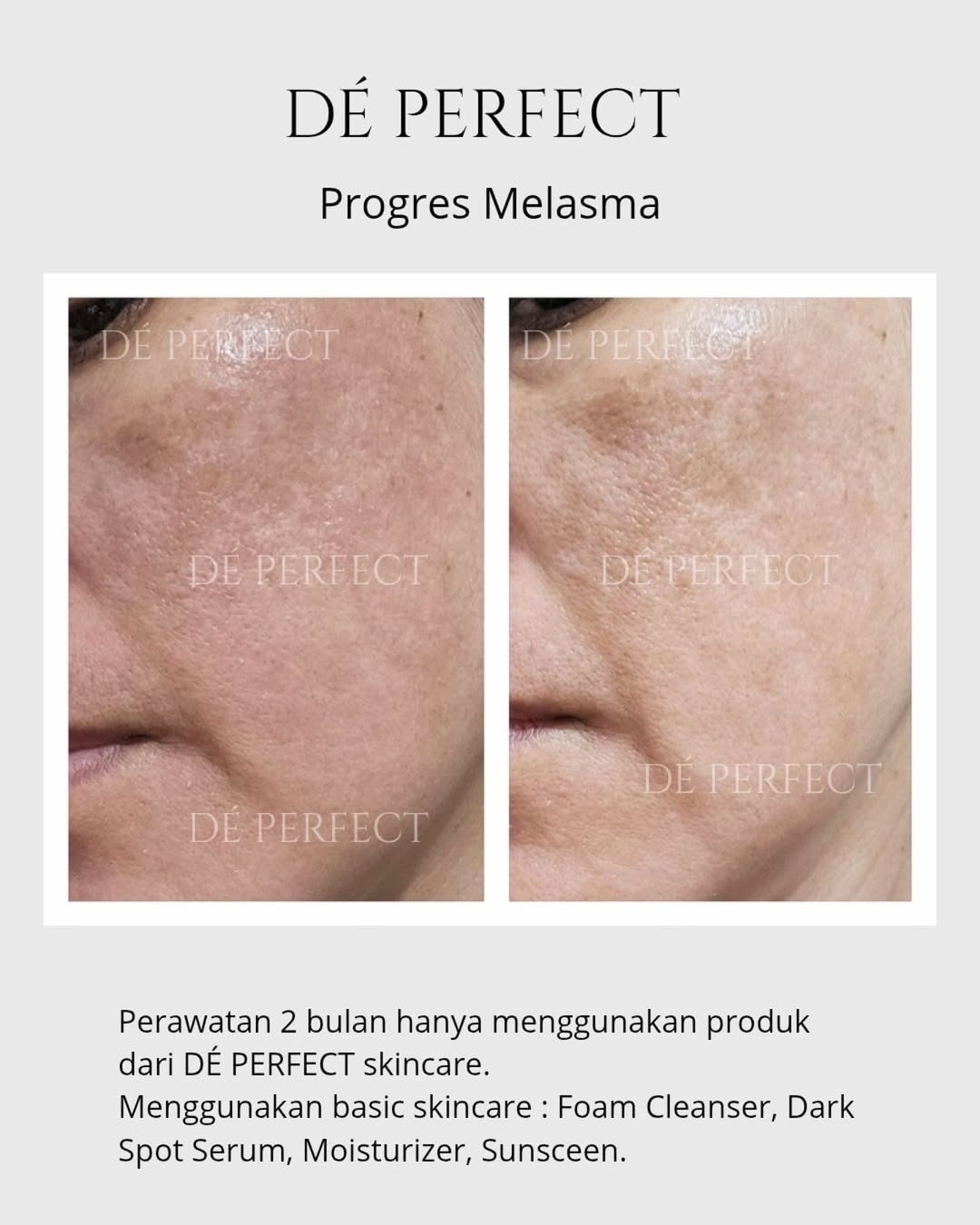 Progres Melasma Kulit lembab adalah kunci menyamarkan flek