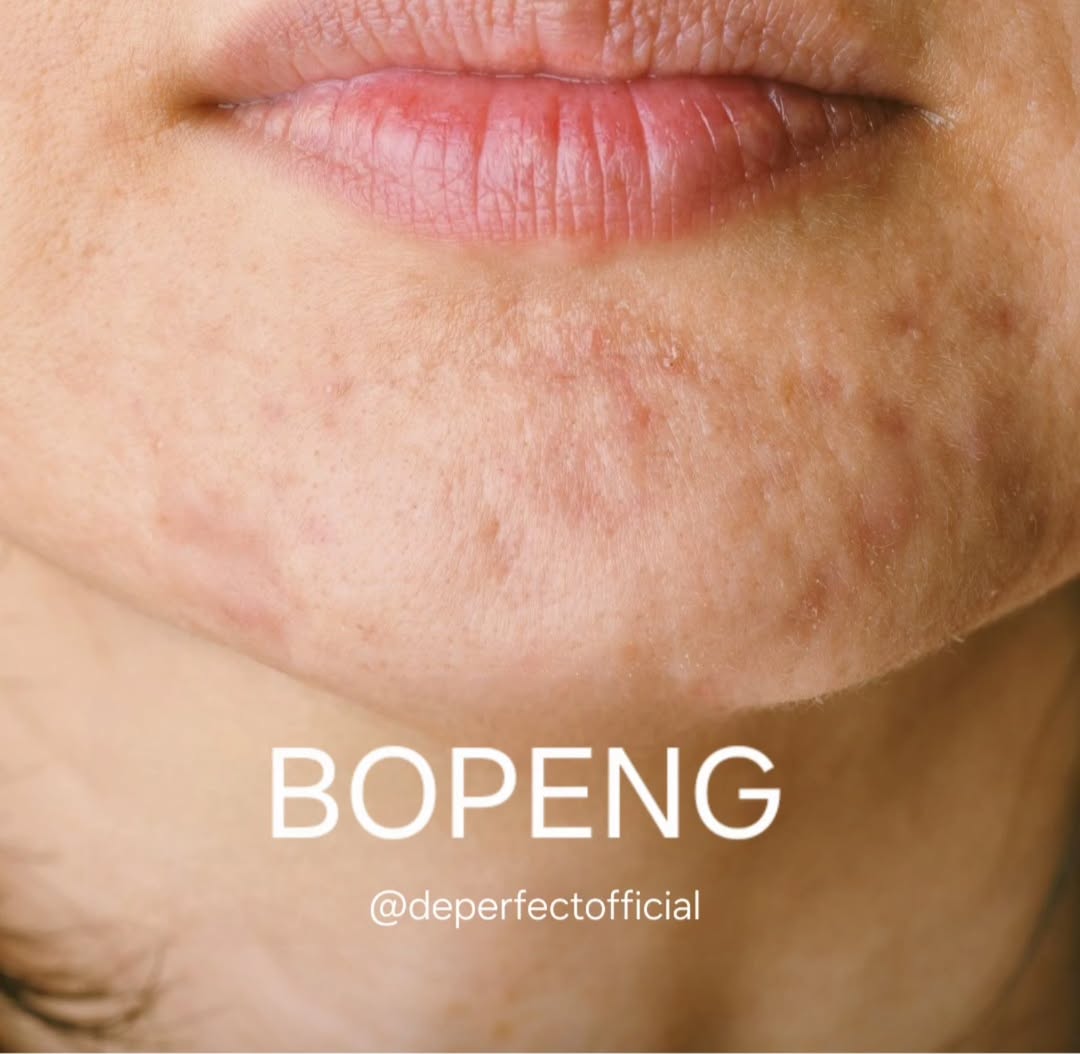 scar atau bopeng