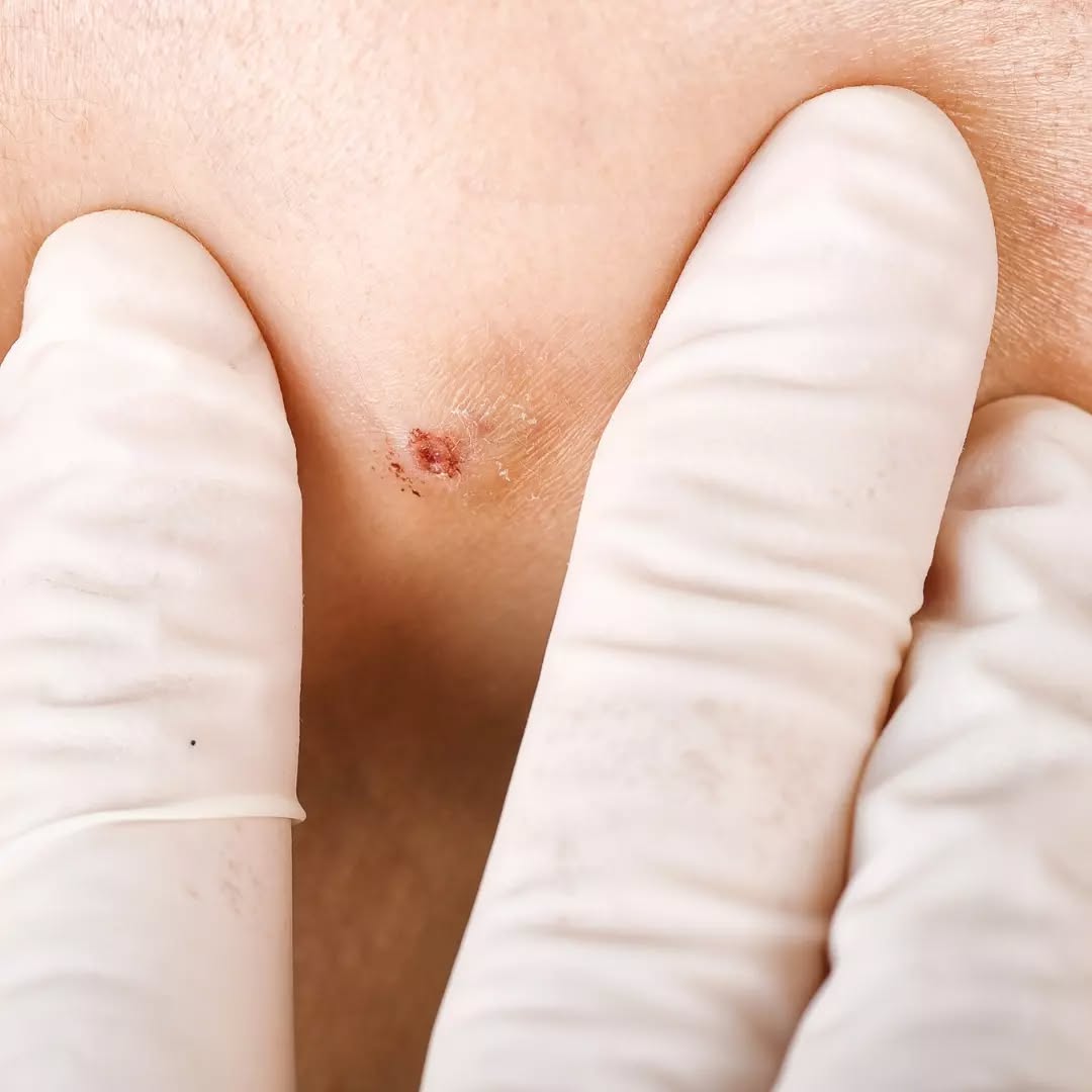 tiba-tiba muncul acne