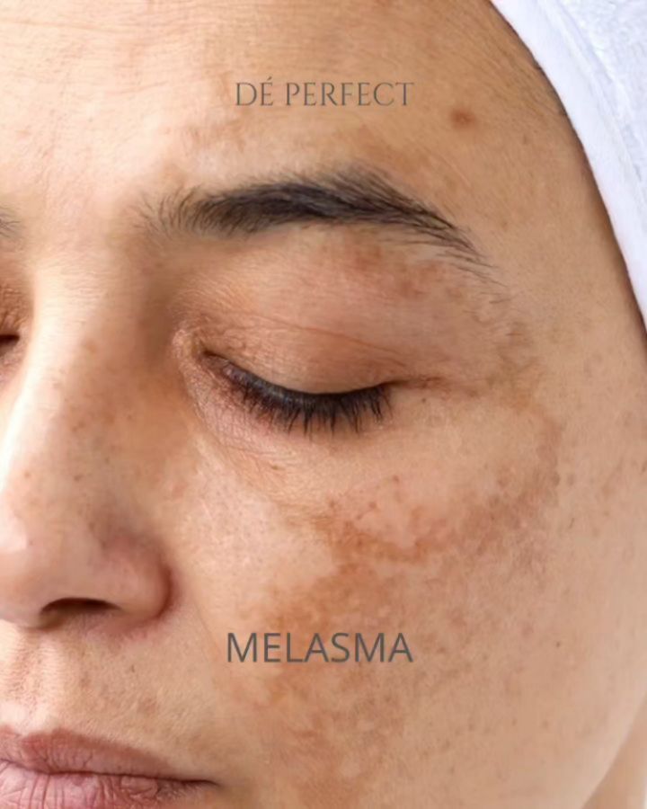 Melasma Biasanya Ditandai Kulit Kering