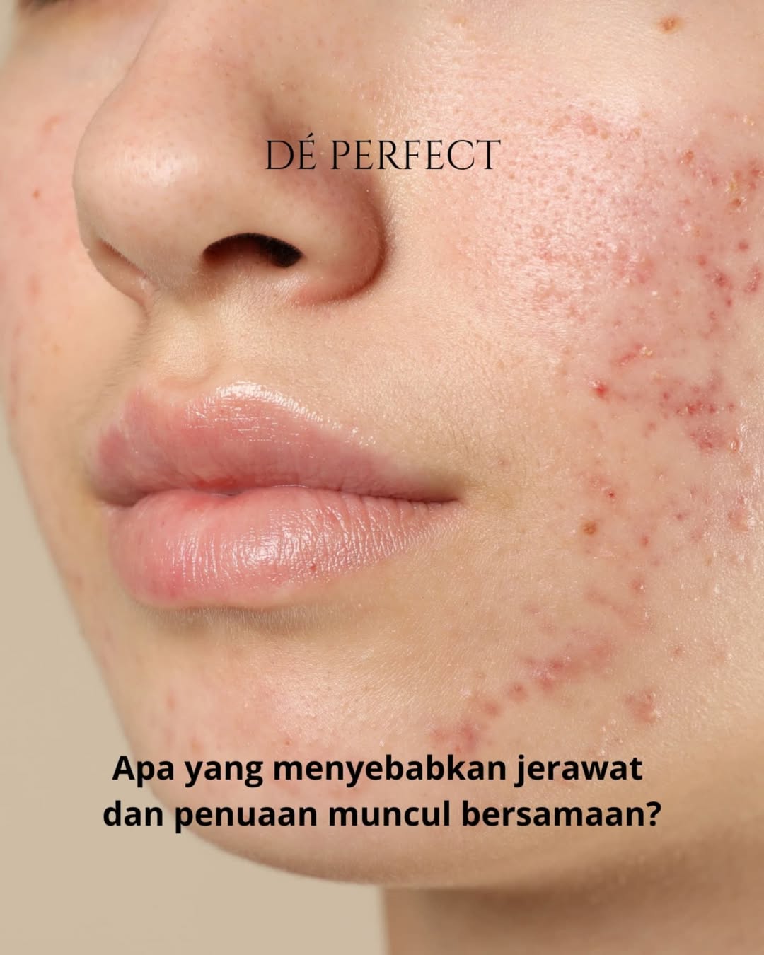 Apa yang menyebabkan jerawat dan penuaan muncul bersamaan Apa yang menyebabkan jerawat dan penuaan muncul bersamaan