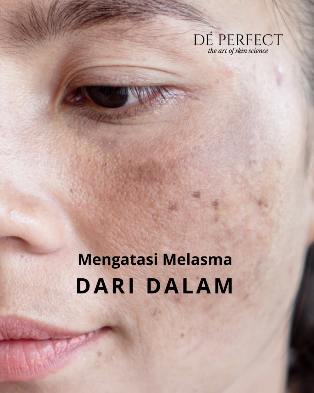 mengatasi melasma dari dalam mengatasi melasma dari dalam