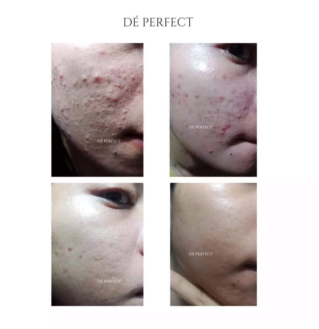seorang acne fighter perjuangan acne fighter