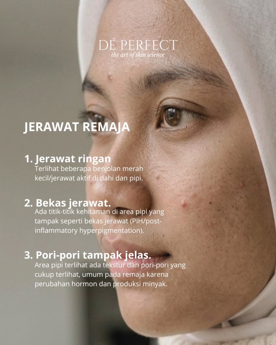 jerawat remaja