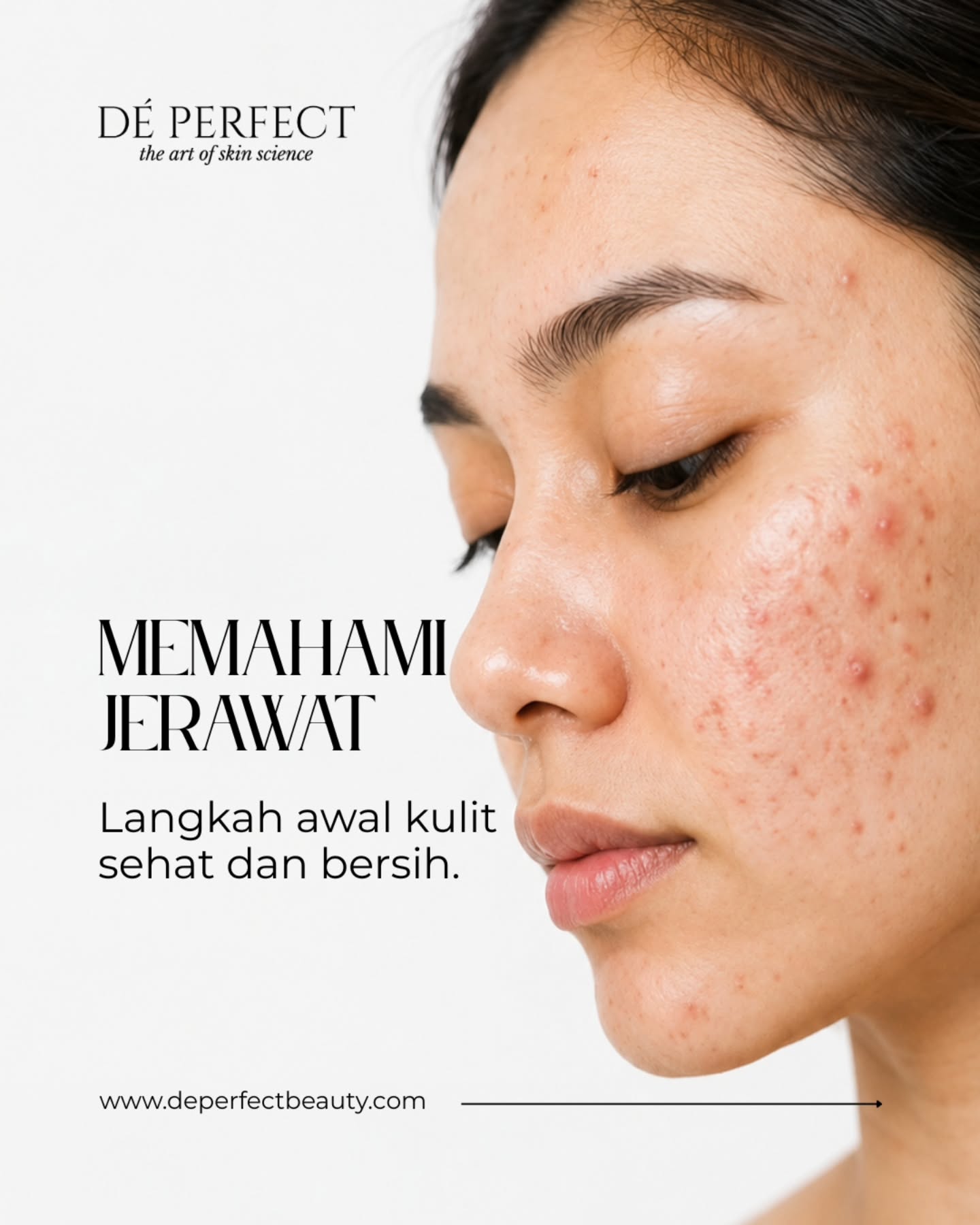 Memahami jerawat